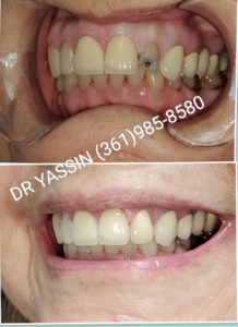 Dr. Yassin transforming patient's smile. Dental services include dentures, dental extractions, mini dental implants, veneers, fillings, crowns, dental cleanings, bridges, root canals, and complete mouth restoration.