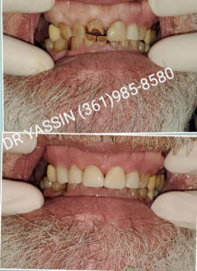 Dr. Yassin transforming patient's smile. Dental services include dentures, dental extractions, mini dental implants, veneers, fillings, crowns, dental cleanings, bridges, root canals, and complete mouth restoration.