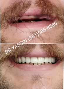 Dr. Yassin transforming patient's smile. Dental services include dentures, dental extractions, mini dental implants, veneers, fillings, crowns, dental cleanings, bridges, root canals, and complete mouth restoration.