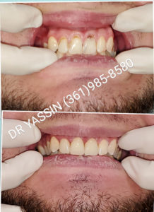 Dr. Yassin transforming patient's smile. Dental services include dentures, dental extractions, mini dental implants, veneers, fillings, crowns, dental cleanings, bridges, root canals, and complete mouth restoration.