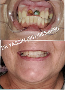 Dr. Yassin transforming patient's smile. Dental services include dentures, dental extractions, mini dental implants, veneers, fillings, crowns, dental cleanings, bridges, root canals, and complete mouth restoration.