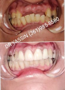 Dr. Yassin transforming patient's smile. Dental services include dentures, dental extractions, mini dental implants, veneers, fillings, crowns, dental cleanings, bridges, root canals, and complete mouth restoration.