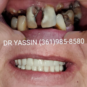 Dr. Yassin transforming patient's smile. Dental services include dentures, dental extractions, mini dental implants, veneers, fillings, crowns, dental cleanings, bridges, root canals, and complete mouth restoration.